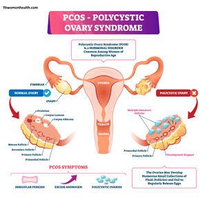 PCOS cause for irregular menstruation